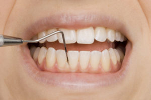 歯周病の原因と対策