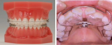 歯の移動・顎の成長の調整