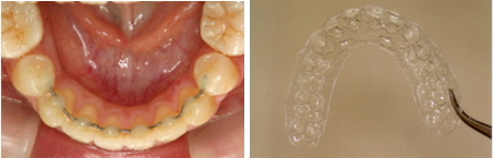 装置の除去と保定開始