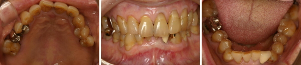 8020を達成された方のお口の中 8020を達成された方のお口の中