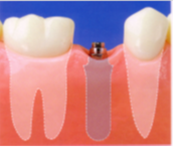 インプラント