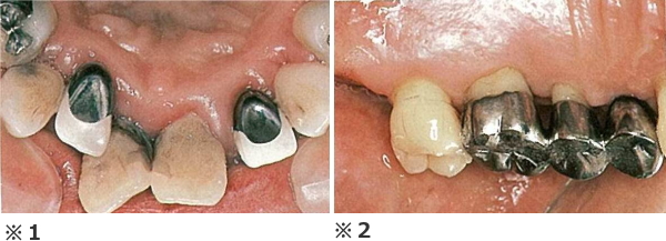 歯の根が露出しているブリッジ、複雑な構造をしている所
