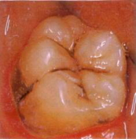 虫歯になっている歯 虫歯になっている歯