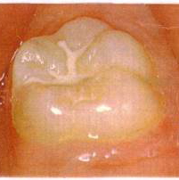 中心の溝だけシーラントでうめます 中心の溝だけシーラントでうめます