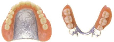 金属床（コバルトクローム）の義歯のイメージ