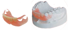 ノンクラスプの義歯
