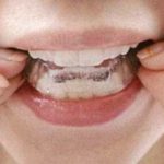 矯正なら豊田市の丸子歯科へ 新しい矯正装置の勉強会