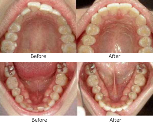 矯正治療前と後