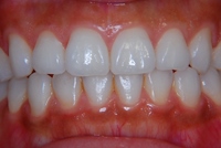 健康な状態の歯肉 健康な状態の歯肉