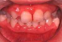 歯肉炎がある状態の歯肉 歯肉炎がある状態の歯肉
