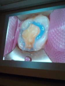 審美修復歯科治療（ＣＲ）講習会 コンポジットレジン