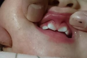 初孫の歯