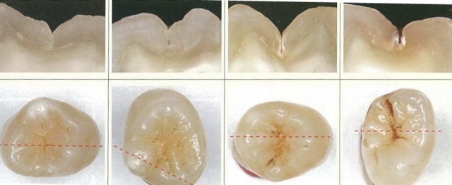 患者さん１人1人の歯の形態はさまざま