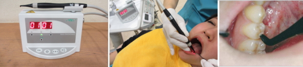 ダイアグノデントというものを使用