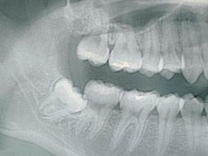 豊田市の丸子歯科　講習会「レントゲンの読み方セミナー」